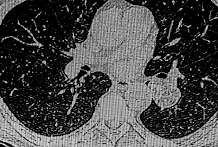 What is popcorn lung?